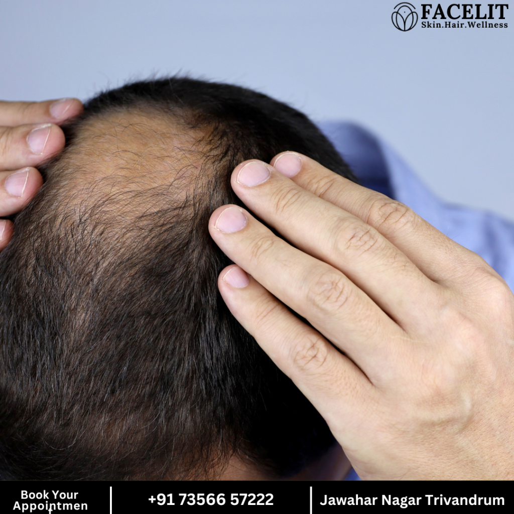 Men's Hair Loss Treatments and Solutions