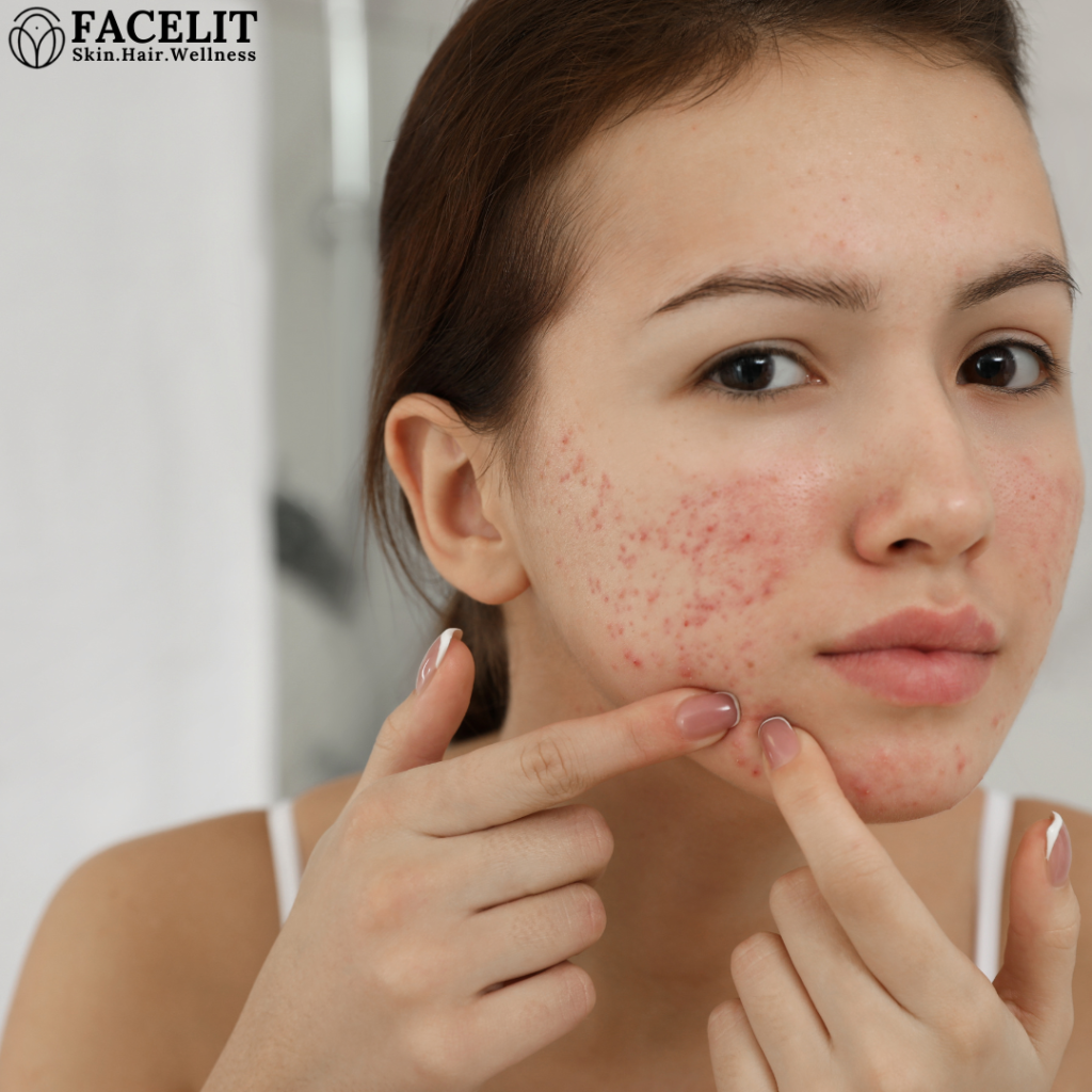 How to Get Rid of Pimples: A Comprehensive Guide to Clearer Skin