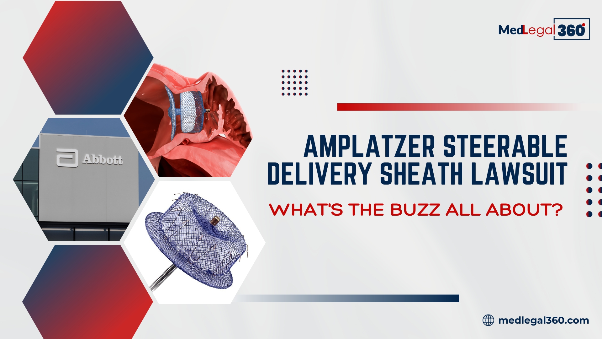 Amplatzer Steerable Delivery Sheath lawsuit: What's the buzz all about?