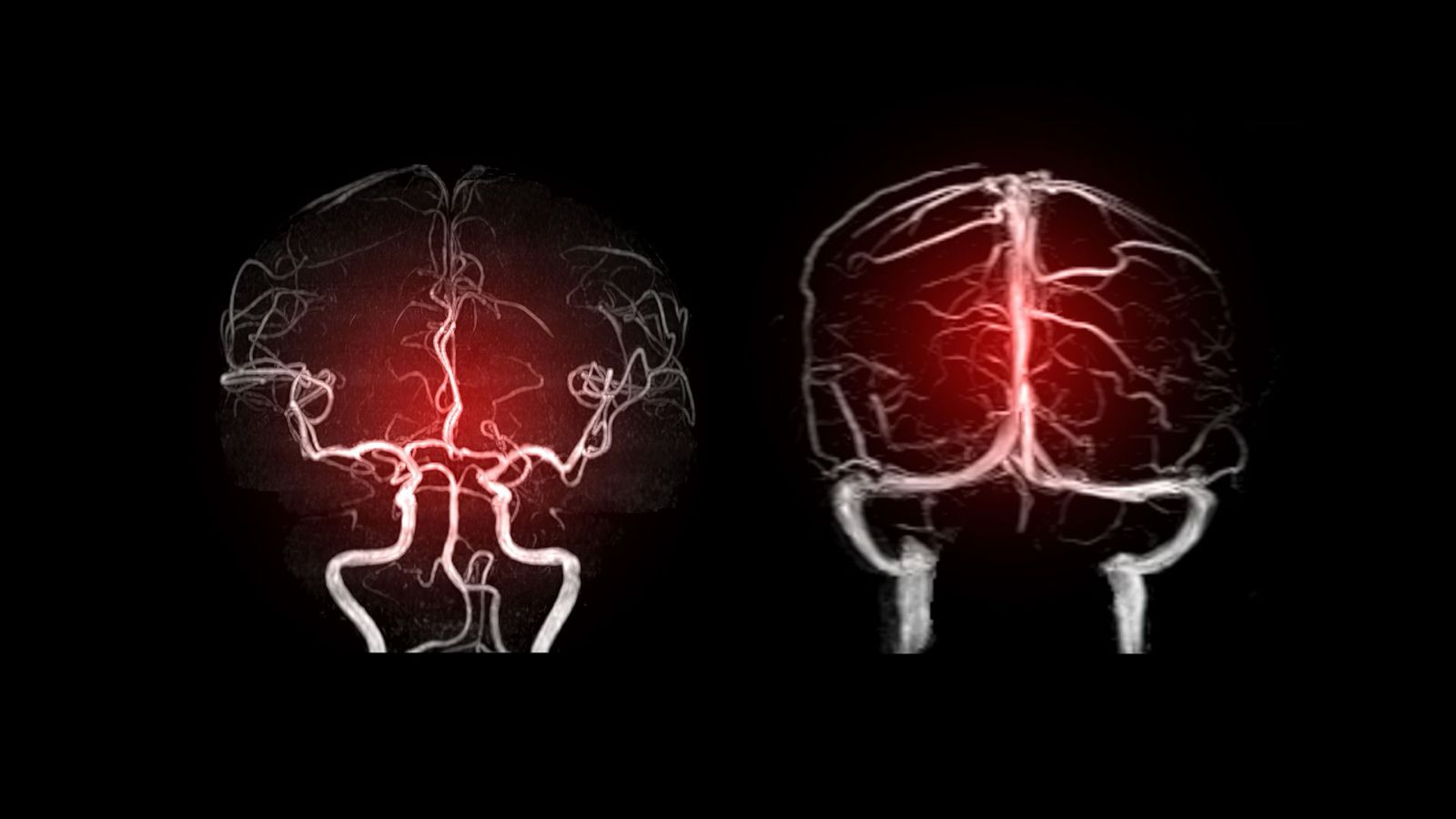 Aneurysm: Types, Risks, Symptoms and Treatment