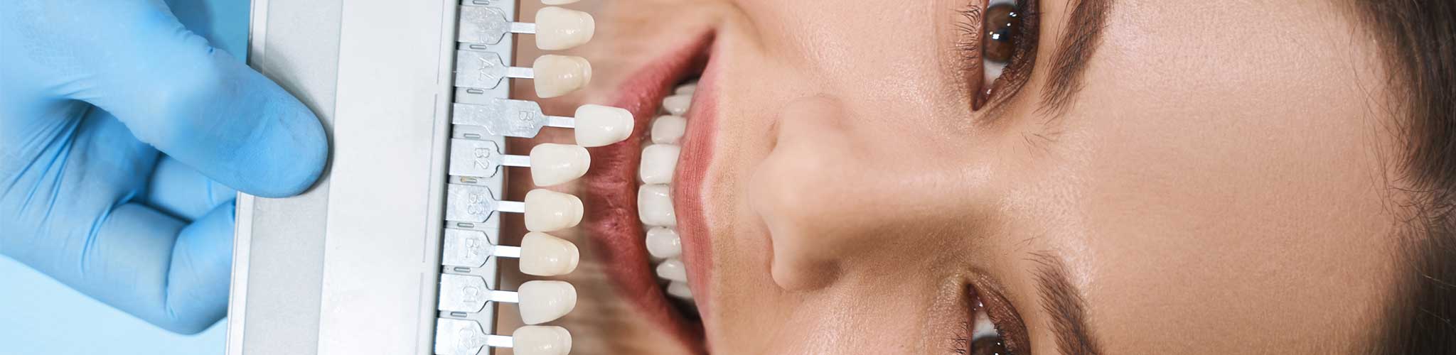 Dental Veneers - DentisTree Dental Clinic