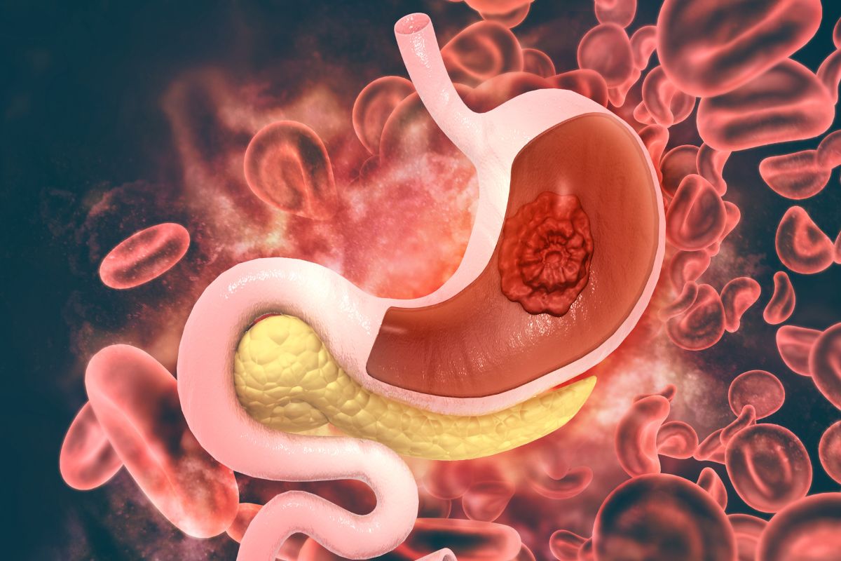 Most Common Peptic Ulcer Disease Symptoms | The Lifesciences Magazine