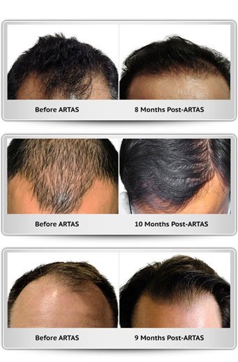 ARTAS Robotic FUE: Advanced Hair Transplant in Dallas | Dallas Men's Hair