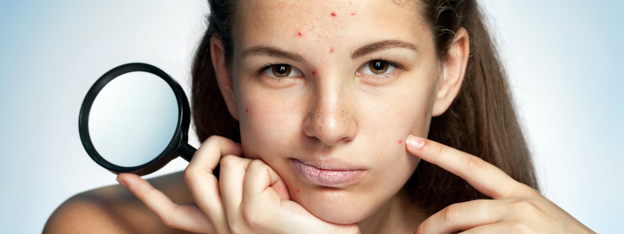 Transform Your Acne-Prone Skin: A Guide to Clearer, Healthier Complexi