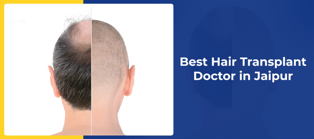 Understanding Hair Transplantation Cost in Jaipur: What to Expect