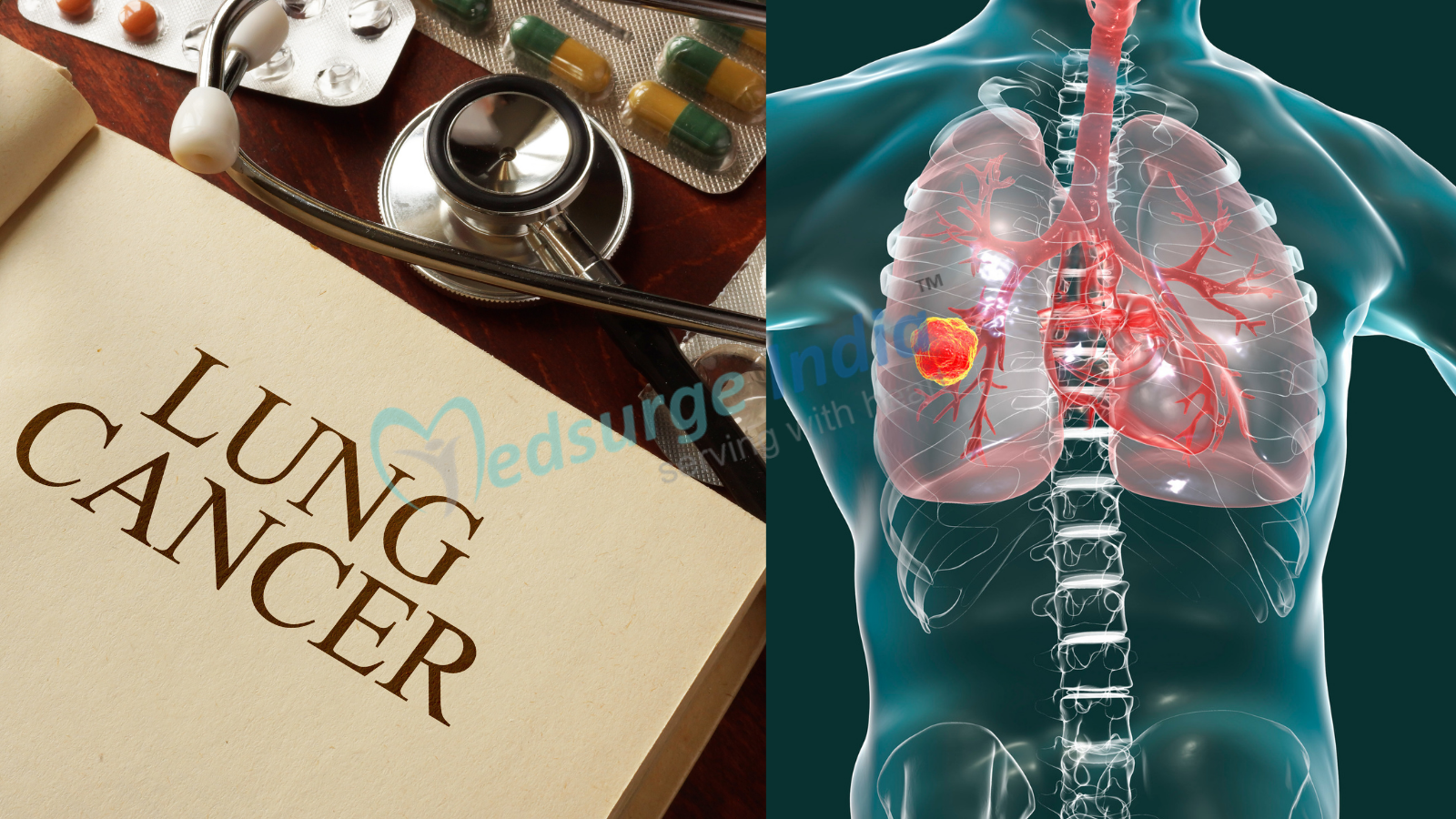 Lung Cancer Treatment Cost In India | Procedure | Treatment - Medsurge India