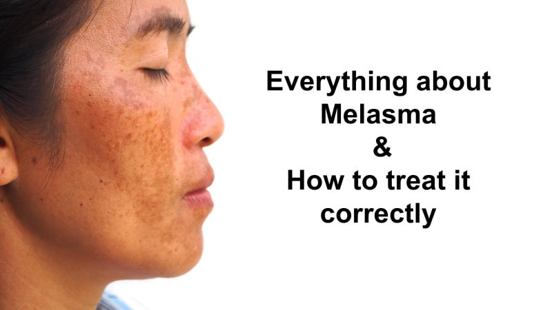 Melasma Treatment in Singapore | The Ogee Clinic