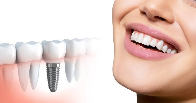 Choosing a Dentist for Dental Implants: A Step-by-Step Checklist