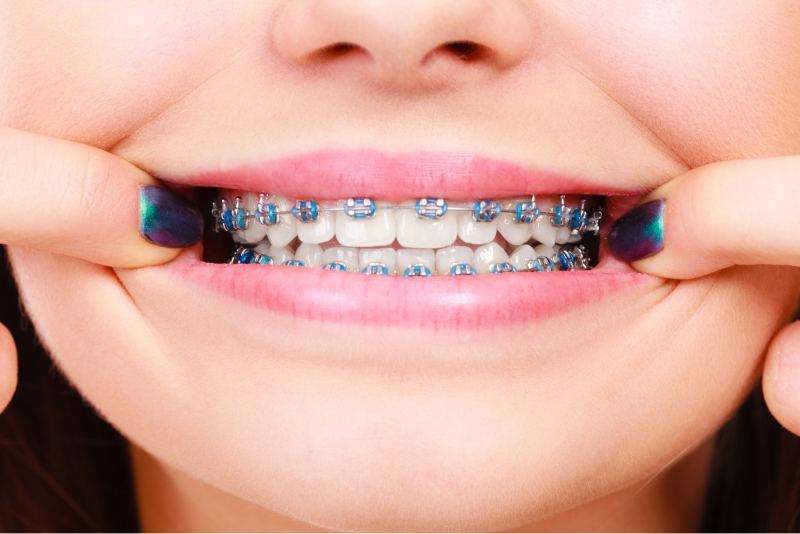 Expert Orthodontics in Portland, TX | Vaani Dental