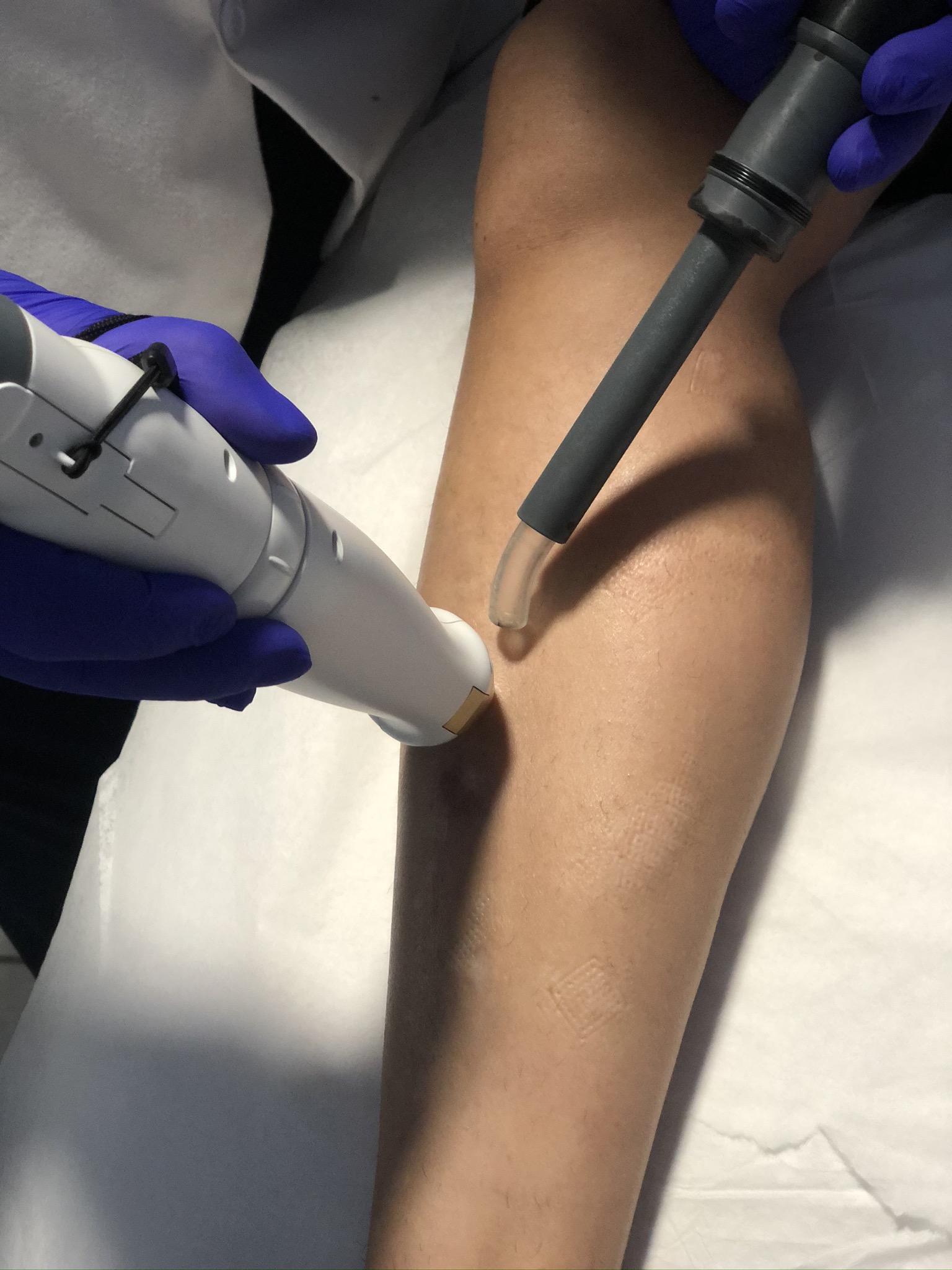 Scar Treatment Laser Removal Orlando | Wymore Laser