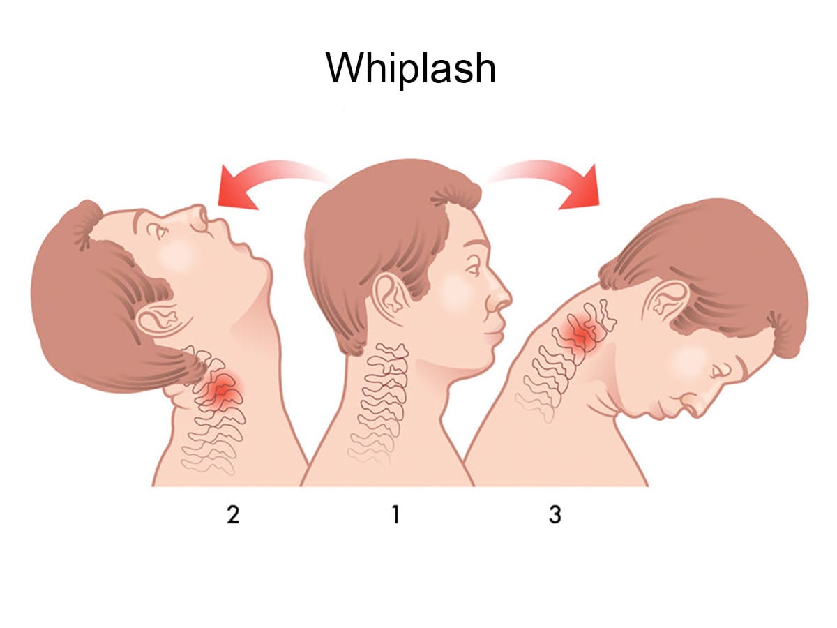 Whiplash Response Regimen Edmonton | Whiplash Injury Clinic