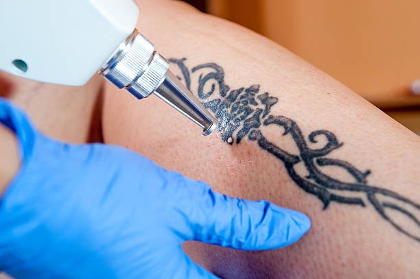 Tattoo Removal Treatment: How It Works, Process, Healing & Scarring - Image Clinic