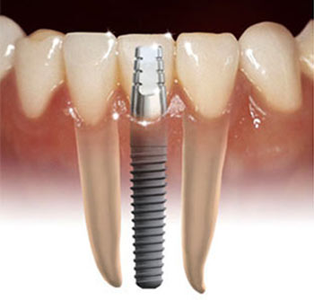 Best Dental Implants Clinic in Mumbai | Trisa Dental Solutions